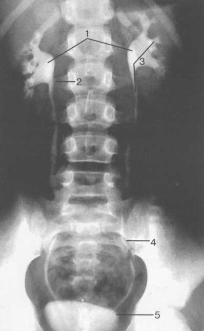 рентгеноанатомия мочеточника